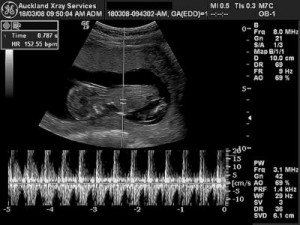 fetal-heartbeat-1
